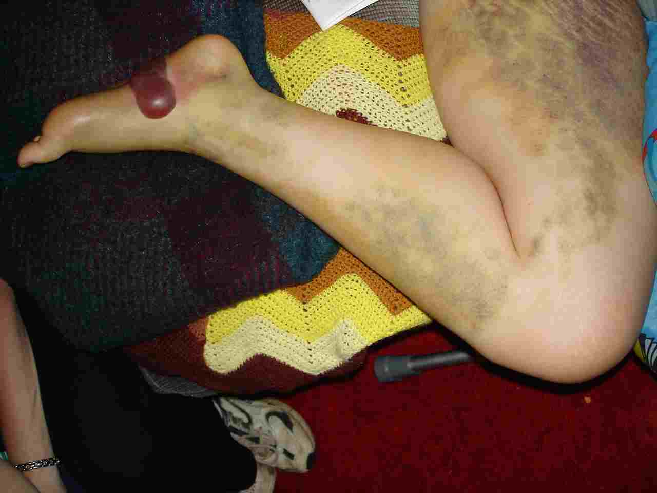 Snakebite